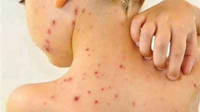 اختصاصية في الأمراض الجلدية تكشف طرق العدوى من مرض الجدري والجرب