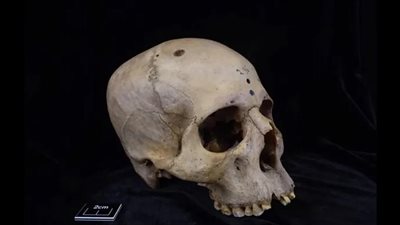 اكتشاف مذهل عن المصريين القدماء... هكذا كانوا يُعالجون سرطان المخ