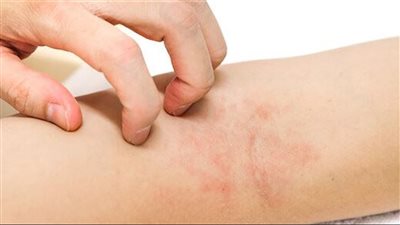 علاج احمرار الجلد والحكة الشديدة بسبب ارتفاع درجات الحرارة