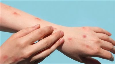 افريقيا تُعلن مرض جدري القرود 