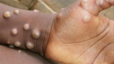 تحذير من وصول مرض جدري القرود إلى لبنان بعد انتشاره في أفريقيا