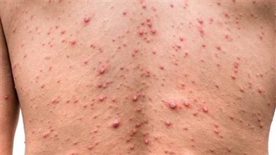بعد كورونا... هل يمكن أن يتحول جدري القردة لجائحة أيضًا؟طب