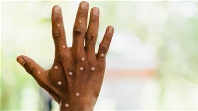 جديد جدري القردة .. هذا ما كشفته الصحة العالمية!