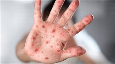 علماء أفارقة يكشفون.. هذا هو سبب تفشي 