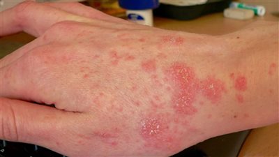 بعد اكتشاف حالات جرب في بعض مراكز الإيواء... ما هي أعراضه وكيف يمكن الوقاية منه؟