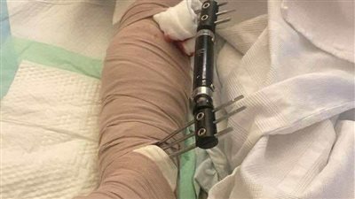 خلاف على صرف الدولار ينتهي ببتر ساق شاب سوري في بعلبك